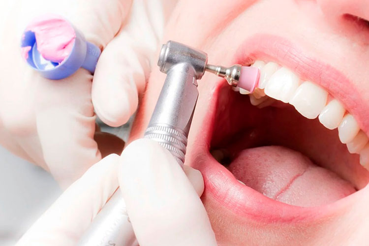 Отличная профилактика периимплантита – профессиональная чистка зубов